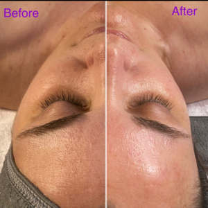 A before and after image of a woman's face after receiving an exfoliating treatment. The right side of the image shows the results. The woman's skin is brighter and smoother.