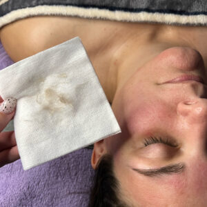 A woman laying on a table after having receive a dermaplane. Next to her is a white cloth with the removed hair and dead skin cells to show the effectiveness of the dermaplane technique.